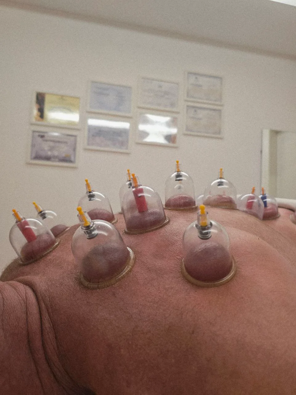 עיסוי ידני בשילוב כוסות רוח